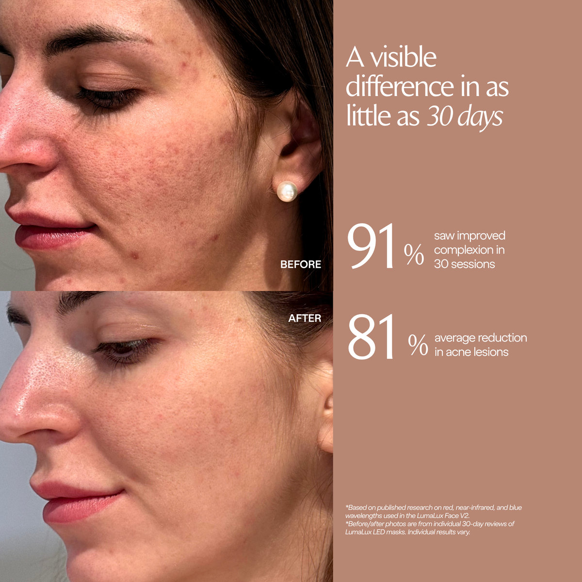 Testimonianza LumaLux Face V2 con foto delle guance prima e dopo e percentuali di studio