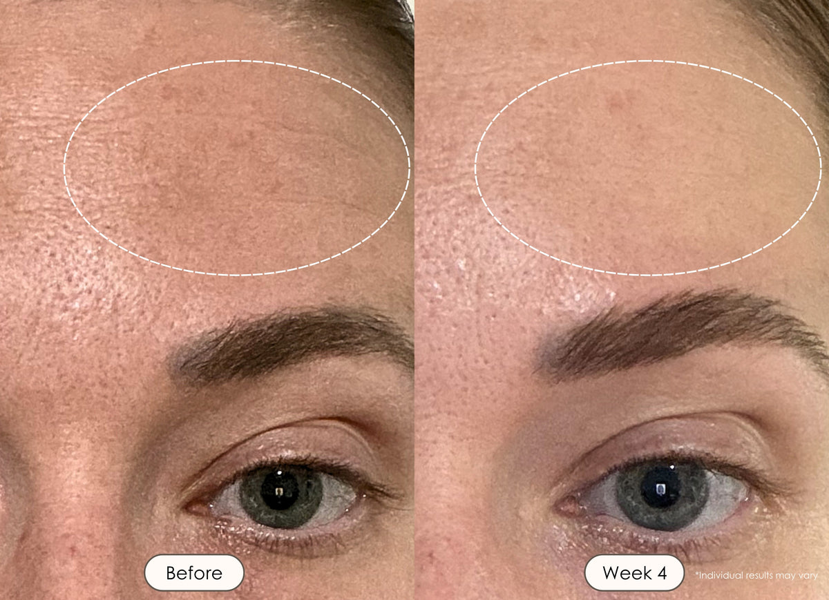 Before and after skincare results of a woman showing smoother forehead skin after 4 weeks.
