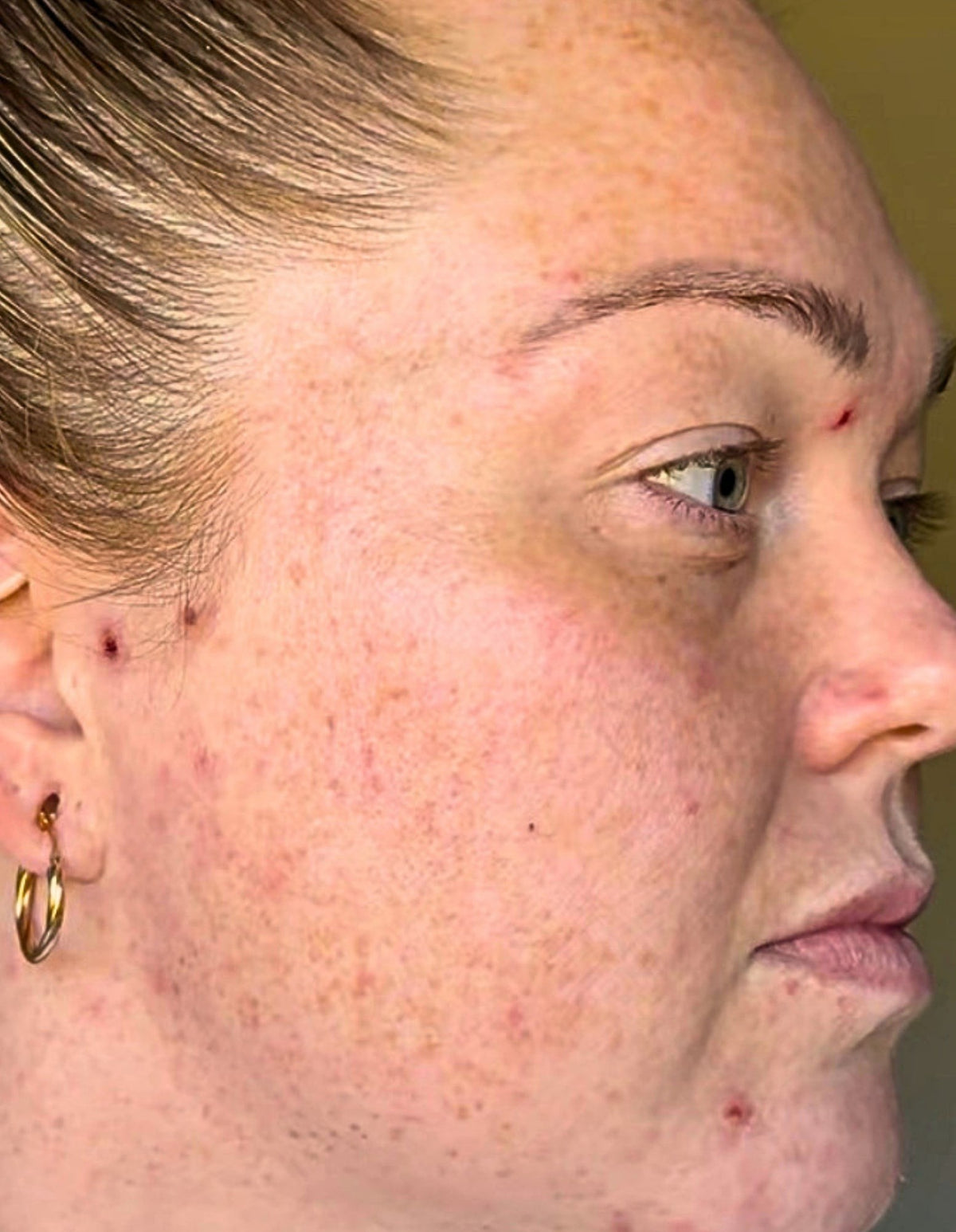 Stacey before using LumaLux Face